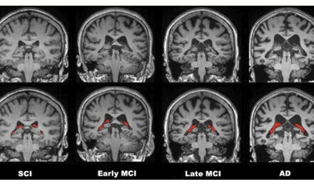 Brain Tomorrow: MRI could detect Alzheimer’s prior to symptoms