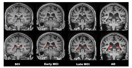 Brain Tomorrow: MRI could detect Alzheimer’s prior to symptoms